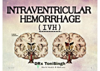 intraventricular hemorrhage.pdf
